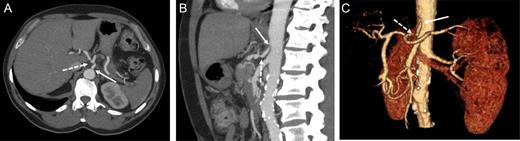 Contrast-enhanced CT in the arterial phase: axial (A) and sagittal (B) maximum intensity projections (MIP), and coronal oblique 3D volume-rendered (VR) images (C) demonstrating proximal celiac artery narrowing (arrow) due to compression by the median arcuate ligament. Downstream, an additional high-degree stenosis of the celiac trunk can be appreciated (dashed arrow).