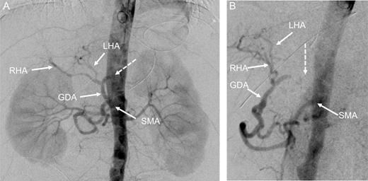 Digital subtraction angiography (DSA) with pigtail catheter placed in the abdominal aorta: coronal (A) and 70° left anterior oblique (LAO) projections (B) demonstrating complete occlusion of the celiac trunk (dashed arrow). In addition, retrograde filling of the GDA can be appreciated through the patent SMA. RHA, right hepatic artery; LHA, left artery.