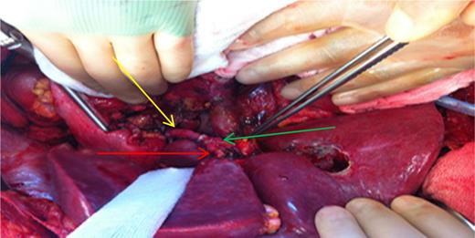 Intraoperative demonstration of reconstruction. Yellow arrow: reconstructed graft. Red arrow: left hepatic artery. Green arrow: right hepatic artery. Pensete shows Choledoch.
