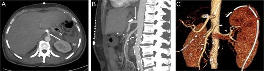 Contrast-enhanced CT in the arterial phase after celiac trunk reconstruction: axial (A) and sagittal (B) MIP, and coronal oblique 3D VR images (C) demonstrating patent reconstruction with an iliac graft (arrow).