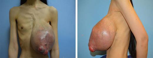 The left breast mass measured 25 × 20 cm with skin ulceration and severe disfigurement. The contralateral breast was normal.