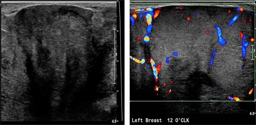 Left breast ultrasound demonstrates a heterogeneous solid mass with internal vascularity replacing the normal breast tissue.