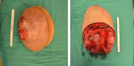 The excised mass, ∼20 × 20 × 25 cm in size.