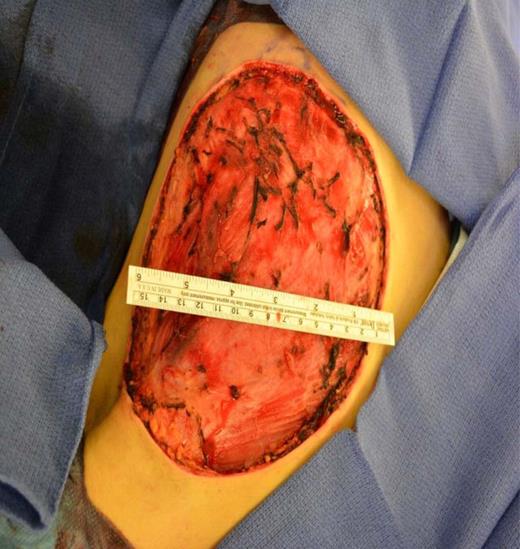The left chest wall defect after tumor resection.