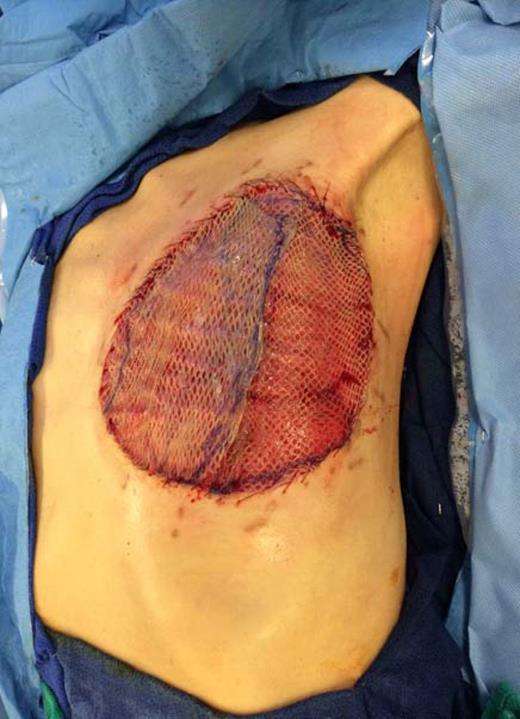 Coverage of the left chest wall defect with a split thickness skin graft.