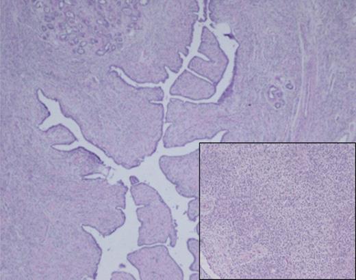 Histological analysis of the surgical specimen demonstrated a diffuse fibroepithelial lesion showing an intracanalicular growth pattern. Lobular architecture is preserved for the most part, and a variably cellular stromal component was seen throughout with focal stromal overgrowth pattern. Densely cellular spindle cell component was also noted (inset).