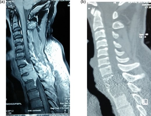 Preoperative gadolinium-enhanced MRI (a) and CT (b) showing expansile lytic tumor at D1 and D2 and compression of the cord at these levels.