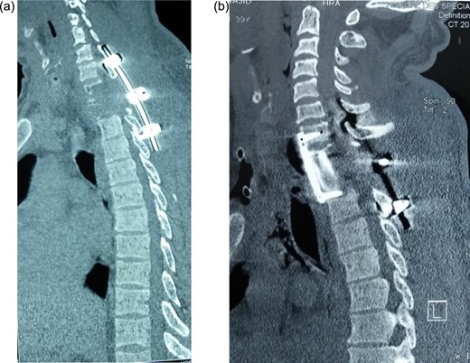 Postoperative sagittal CT showing (a) hook and rod stabilization posteriorly, and (b) bone graft and plate fixation anteriorly after corporectomy of D1 and D2.