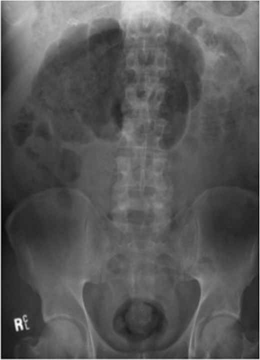 Plain AXR (Case 1) revealed dilatation of a focal segment of a large bowel with a mildly dilated small bowel.