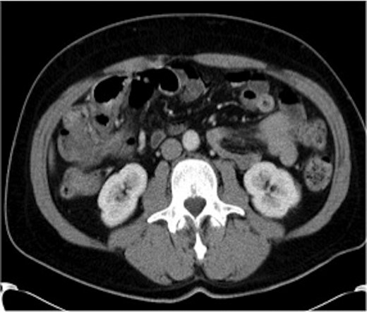CT of the abdomen (Case 1) demonstrating the gas-filled caecum.