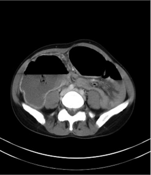 CT of the abdomen (Case 2) showing a calibre change within the transverse colon with no mass lesion.