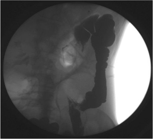 Gastrografin enema (Case 2) demonstrating no flow beyond the mid-transverse colon.