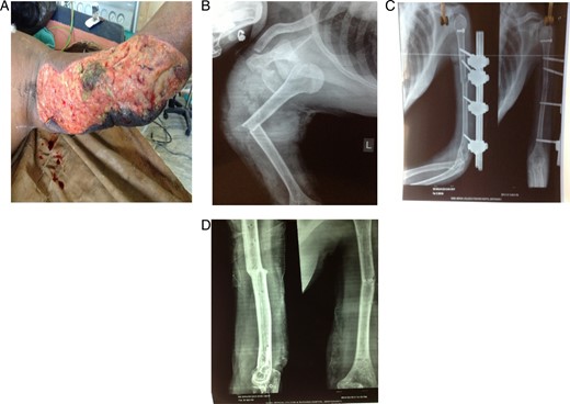 (A) Clinical picture at the time of presentation to emergency. (B) Preoperative X-ray of left shoulder with arm anteroposterior view showing dislocation of shoulder, greater tuberosity fracture and humerus mid-shaft fracture. (C) Postoperative X-ray showing shoulder reduction, greater tuberosity fracture fixation with a cannnulated screw and humerus fracture fixed with external fixation. (D) Four months postoperative X-ray showing fracture union.