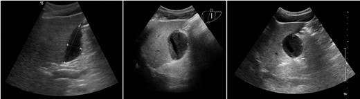 Ultrasound on postoperative Days 14 (left), 21 (middle) and 31 (right). Liver is on the left in each image, and the persistent collection is demonstrated within the gallbladder fossa.
