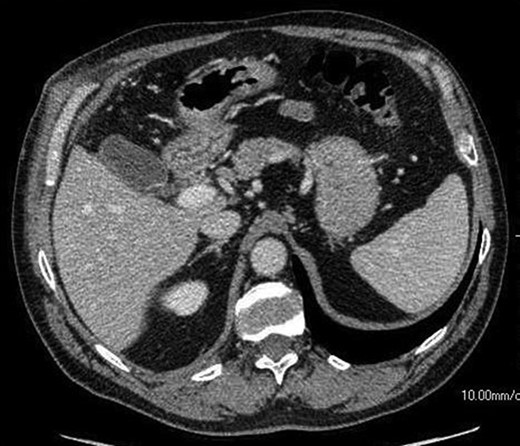 An axial CT image shows collection in the gall bladder fossa closely resembling a normal gallbladder appearance.