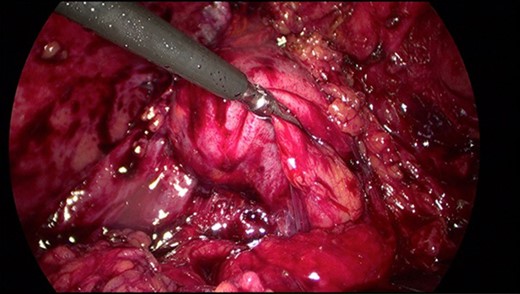Intraoperative image of Hartmann's pouch (held by graspers) in continuity with a reformed gallbladder.