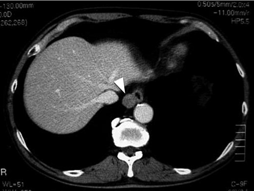 Chest CT of a 62-year-old male. The white arrow head indicates a clearly distinguishable mass having a smooth surface at the right side of the lower esophagus.