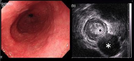 Endoscopic examination and endoscopic ultrasonography. (a) Tumor with a normally appearing mucosa was located 40 cm from the incisor teeth. (b) Hypoechoic submucosal tumor (asterisk) with annular localization, arising from the submucosal layer.