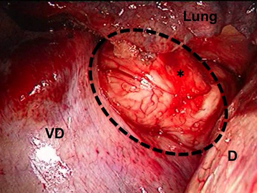 Thoracoscopic view of the tumor. The image shows bulging through the right thoracic cavity. The black dash line and asterisk indicate the GIST; D, the diaphragm; VD, the vertebral body.
