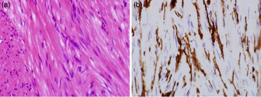 Histological specimens prepared from the removed GIST. The left and right microphotographs were taken at a magnification of ×40. (a) Hematoxylin and eosin-stained specimen showed spindle cells. (b) Immunohistochemical-stained specimen showed that the cells were positive for c-KIT.