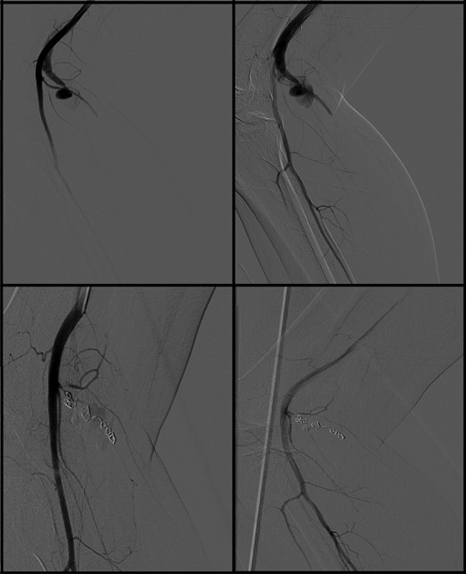 Digital subtraction angiography showed active blush of the sural artery and AV fistula with proximal filling (upper two images). After coiling procedure, hemostasis was accomplished (lower two images).