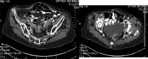 A CT scan of small bowel fistula to the anal pouch.