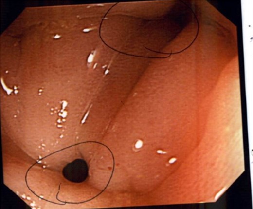 Colonoscopy demonstrating several fistulae into the anal pouch.