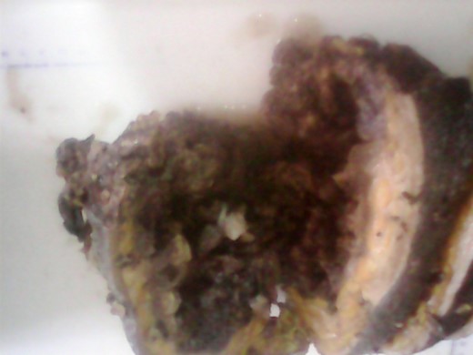 Gross mastectomy specimen for MBC melanocytic variant.