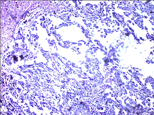 Metastasizing glandular component of MBC, melanocytic variant, with few pigment deposits.