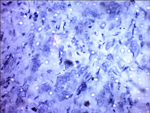 ER negativity for rabbit monoclonal antibodies. Few stromal cells are positive black.