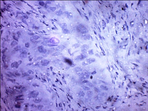 PR-negative immunohistochemistry typing with rabbit progesterone antibodies.