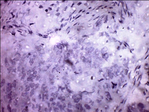 Her-2 Neu receptor-negative.