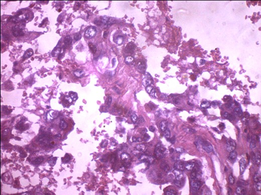 Glandular component of the tumour.