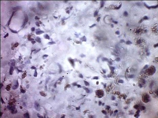 S-100 cytoplasmic positivity in keeping with melanocytic differentiation. Immunohistochemistry.
