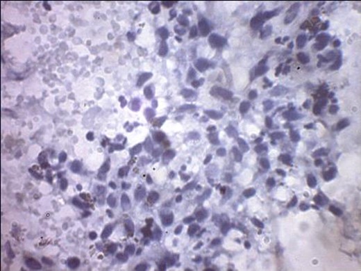 Tyrosinase positivity in keeping with melanocytic differentiation.