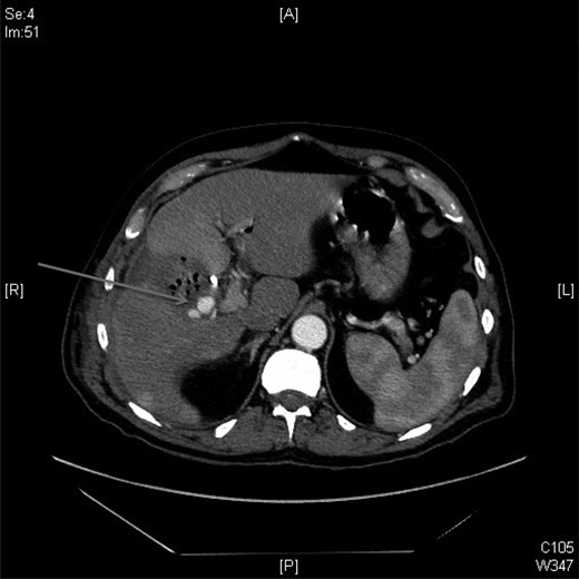 A CT scan showed replaced right HAP inside the collection (straight arrow).
