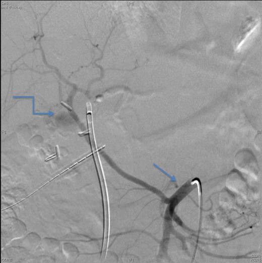 An angiographic scan showed superior mesenteric artery (straight arrow) and replaced right HAP (angulated arrow).