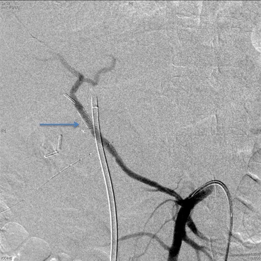 An angiographic scan showed stent in the replaced right hepatic artery.