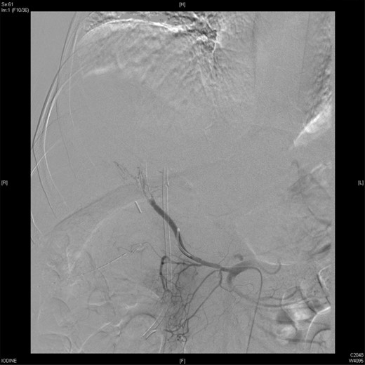 An angiographic scan showed reduced flow in the stented replaced right hepatic artery.