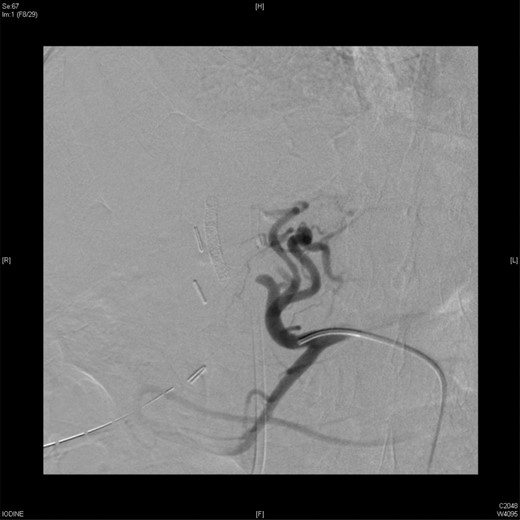 An angiographic scan showed left HAP after a gel foam.