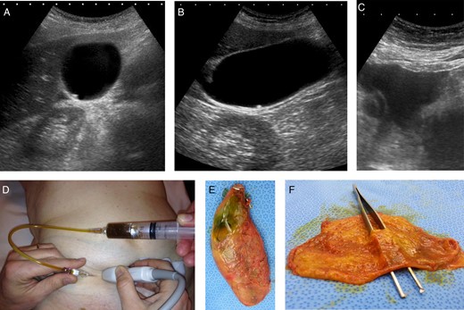 (A–F) Ultrasound shows an easily compressible, non-hydropic gallbladder and a small, mobile stone at the bottom of the gallbladder (A and B). In the right lower quadrant of the abdomen, free fluid is visible (C). Punction and aspiration of the fluid confirms that the free fluid is bile (D). During laparoscopy, a leaking gallbladder is seen, after cholecystectomy and opening of the gallbladder a perforation is confirmed (E and F).
