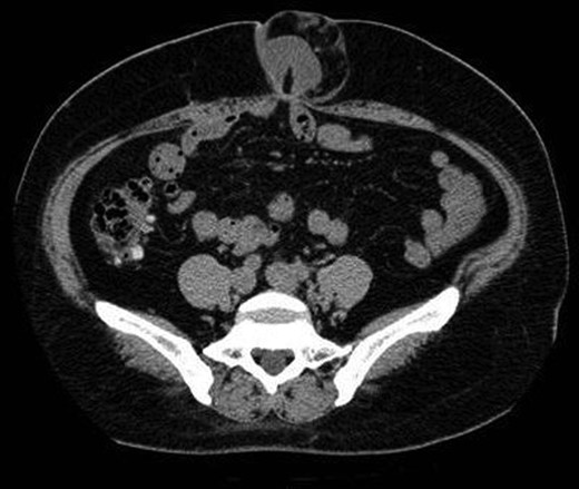 A computed tomographic scan showing the umbilical hernia and an incarcerated portion of the small intestine. The size of the hernial orifice was ∼2 cm.