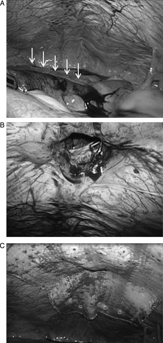 (A) The strangulated portion of the small intestine was reddish and congested; however, there was no evidence of necrosis or perforation (white arrows). (B) The size of the umbilical hernial orifice was ∼2 × 2 cm. (C) Composite mesh covering the hernial defect by at least 5 cm in all directions. The mesh was fixed to the abdominal wall circumferentially using a tacking instrument.