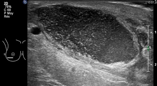 Right breast ultrasonography (US) showing encapsulated purulent collection (4 × 4 × 15 cm) in correspondence of the lower lateral quadrant, 7 weeks after breast reduction surgery. Abscess drainage was performed under US guidance.
