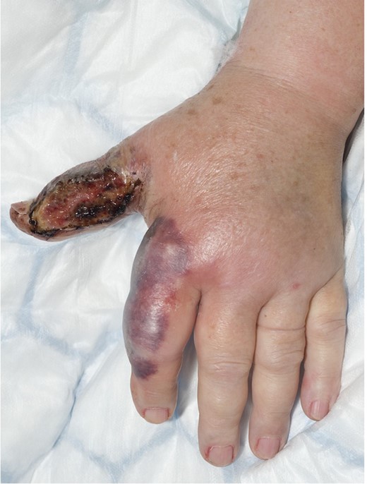 The plaques grew and the skin deteriorated with intravenous antimicrobials alone.