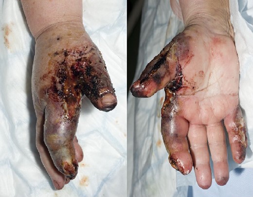 The debridement had no effect and the bullae grew, along with new lesions on non-adjacent digits.
