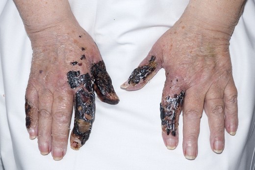 The hands at a clinical appointment at 1 month.