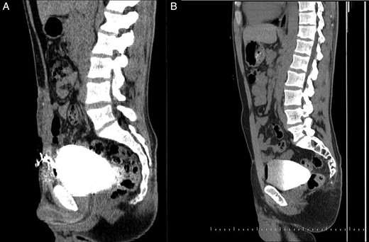 (A) A CT cystogram demonstrates an aberrant connection between the anterior bladder wall and the external surface of the skin. (B) A CT cystogram shows no leakage from the bladder on postoperative day 21.