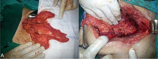 (A) An omental V-shaped flap prepared to enhance repair of VCFs. (B) An omental flap was sutured and quilted on the bed of the anterior bladder wall.