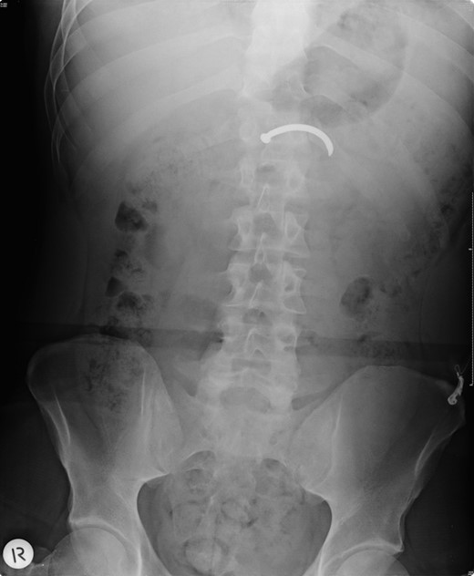 Plain abdominal radiograph showing the position of a single nail in the abdomen.